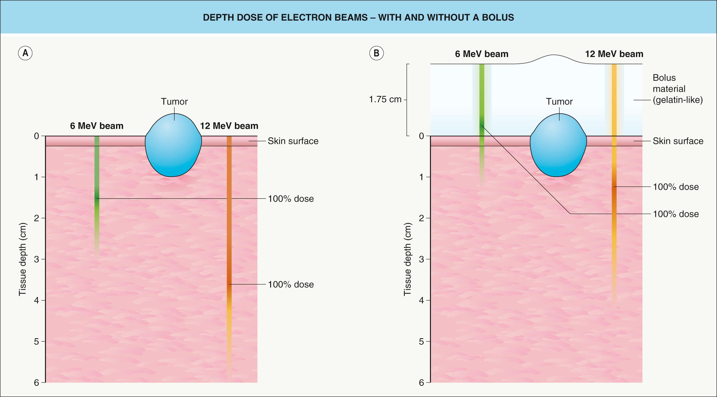 Fig. 139.2, Depth dose of electron beams – with and without a bolus.