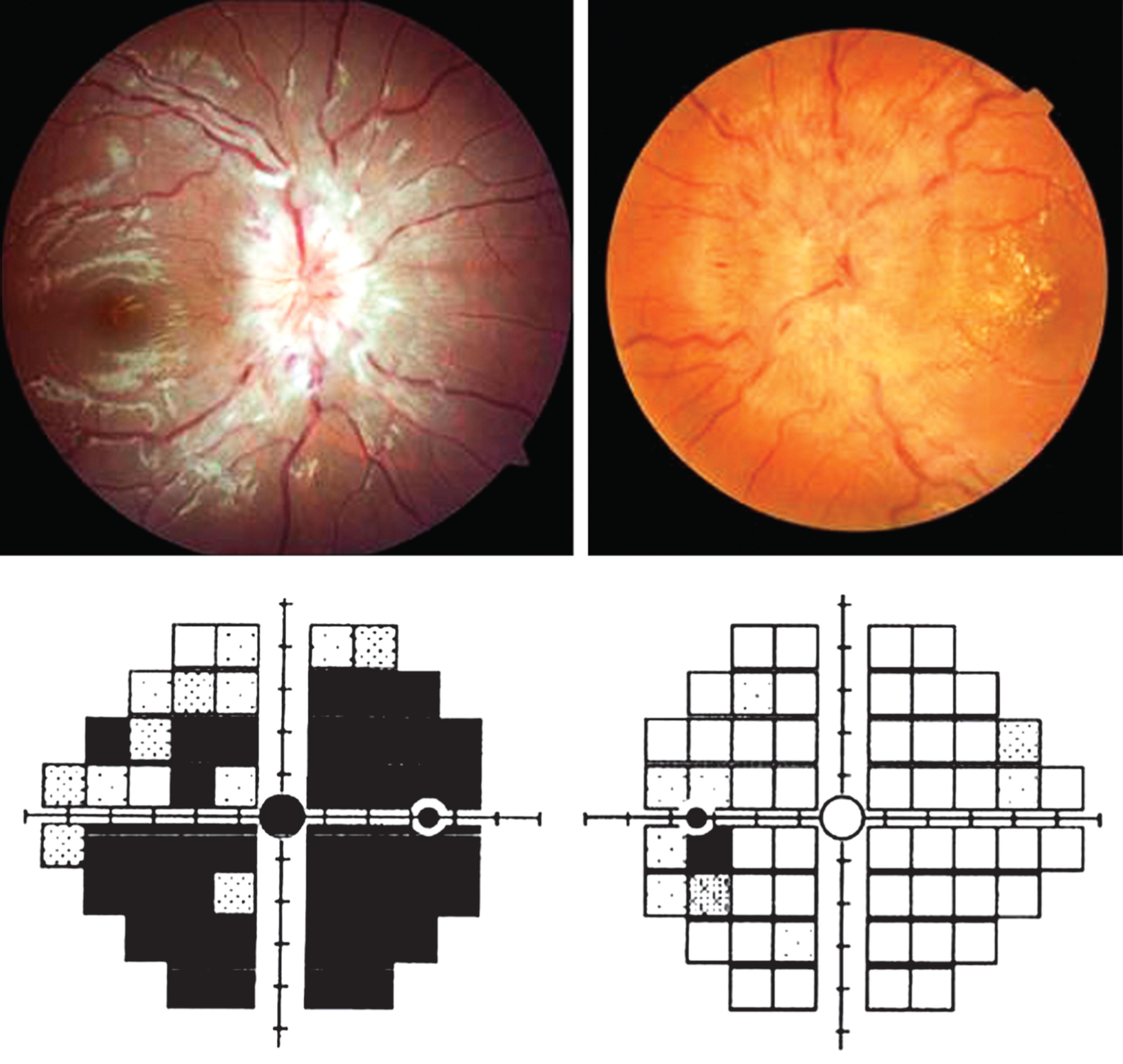 Fig. 59.1, Optic nerve swelling secondary to raised intracranial pressure. (Left panel) Marked swelling, in the setting of 20/30 acuity and severe visual field loss. (Right panel) Marked swelling, hemorrhages, and macular lipid in the setting of 20/20 acuity and very mild blind spot enlargement.