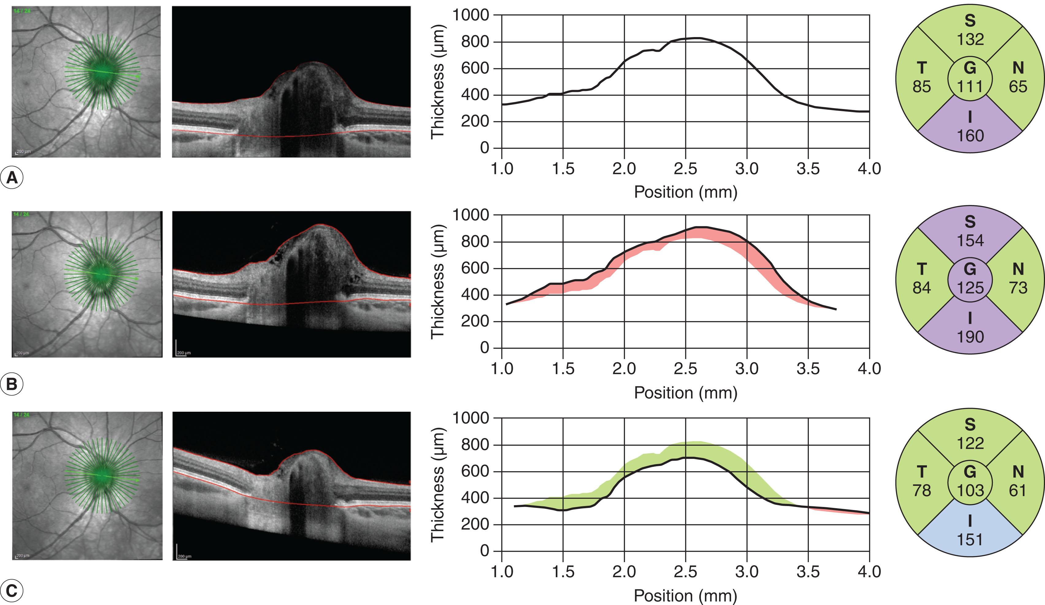 Fig. 59.2, Progressive optic nerve swelling in an asymptomatic child with stable hydrocephalus. (A) A slightly elevated optic nerve and normal retinal nerve fiber layer (RNFL) thickness for all quadrants except the inferior. (B) Depiction of the increasing optic nerve height (red shading) along with progressive elevation in the superior and inferior quadrants. After placement of a ventriculoperitoneal shunt, the optic nerve swelling and RNFL thickness declined (green shading) (C).