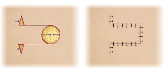 FIGURE 17.1, A unilateral advancement flap displaces dog-ears and creates a U-shaped scar.