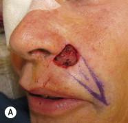 FIGURE 17.11, (A) Island pedicle flap repair of perinasal upper lip defect. (B) Flap is advanced into the defect and the donor site is closed primarily. Note that the flap is slightly undersized and inset to help prevent pin-cushioning. (C) At 1 year after surgery there is no retraction of the lip.