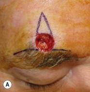 FIGURE 17.5, (A) A bilateral advancement flap (A–T flap) designed so that base of inverted T will be hidden just above the brow. (B) Flap is elevated at the level of frontalis muscle with care taken to preserve supraorbital nerve. (C) Dog-ear redundancy distributed equally along base of inverted T using the rule of halves. (D) Final result at 6 months.