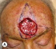 FIGURE 17.6, Bilateral crescentic advancement flaps for repair of a moderate sized defect of the central forehead. (A) Flap designed so that base of inverted T will fall within cosmetic boundary of forehead and eyebrows. (B) Flap elevated above frontalis to preserve supraorbital and supratrochlear nerves. Defect extended to brow to conceal suture line along cosmetic boundary. (C) Immediate result. (D) Final result at 1 year.