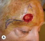 FIGURE 17.7, (A) A unilateral crescentic advancement flap hides the scar line along the superior brow. (B) In this case, a dog-ear redundancy was avoided by removing a crescent of tissue lateral to the brow. (C) 6 months after surgery.