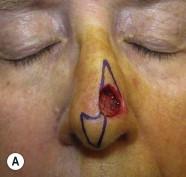 FIGURE 17.8, (A) A Burow's advancement flap (East–West flap) for a Mohs defect on the left nasal supratip allows for dog-ear removal within the midline. (B) Alar symmetry is maintained. (C) Final result at 6 months.