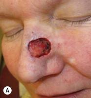 FIGURE 17.9, Crescentic advancement flap. (A) Mohs defect of the nasal sidewall. (B) A crescentic advancement flap offers the ability to hide one curvilinear aspect of the repair within the alar crease and melolabial fold, thus preserving this important cosmetic junction. (C) The curvilinear crescent of tissue that is excised prevents dog-ear formation. (D) Final result at 6 months. While an excellent outcome for a challenging wound, it could have been improved had the surgeon extended the defect to the alar crease inferiorly as marked in (B).