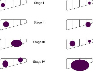 Fig. 86.1, PRETEXT Surgical Staging System for Hepatoblastoma.