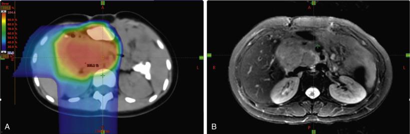 Fig. 86.2, (A) Axial CT simulation and (B) T2-weighted MRI with proton beam therapy plan for a 16-year-old female with recurrent hepatocellular carcinoma. A significant reduction in exposure to liver and contralateral kidney was achieved with protons compared with her photon radiotherapy plan.