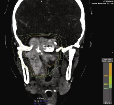 Fig. 86.3, Intensity-Modulated Radiation Therapy (IMRT) Isodose Plan for a Patient With Juvenile Nasopharyngeal Angiofibroma.