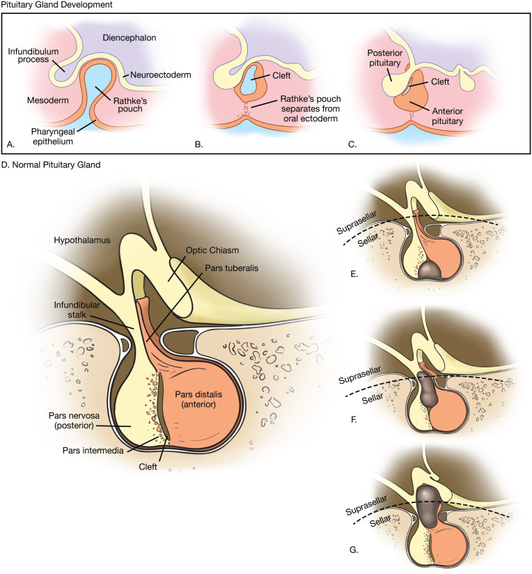 Figure 20.1, Development of Rathke cleft cyst. The normal anterior pituitary gland develops from ectodermal upgrowth and the posterior gland from neuroectodermal downgrowth. During development, a diverticulum known as Rathke pouch separates from the pharyngeal epithelium and grows superiorly toward the developing brain. Eventually the connection to the inferior pharyngeal epithelium is pinched off. The cleft of Rathke pouch in the region of the pars intermedia is generally obliterated early in fetal development. However, a Rathke cleft remnant may persist in a suprasellar or intrasellar location.