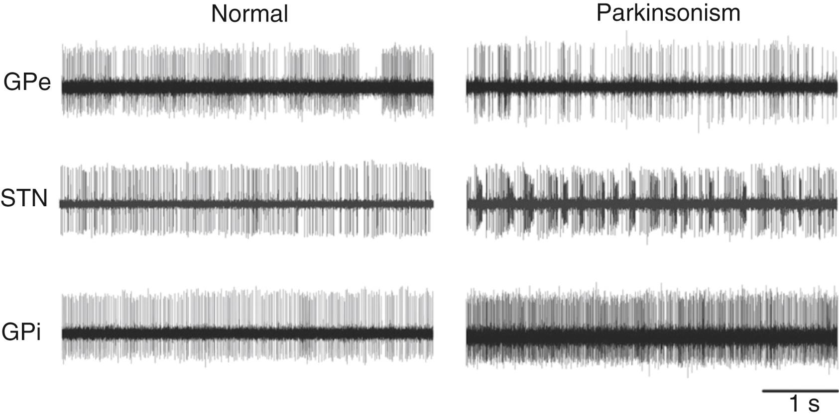 Figure 103.3, Changes in the activity of single cells in external globus pallidus (GPe), subthalamic nucleus (STN), or internal globus pallidus (GPi) of MPTP-treated monkeys.