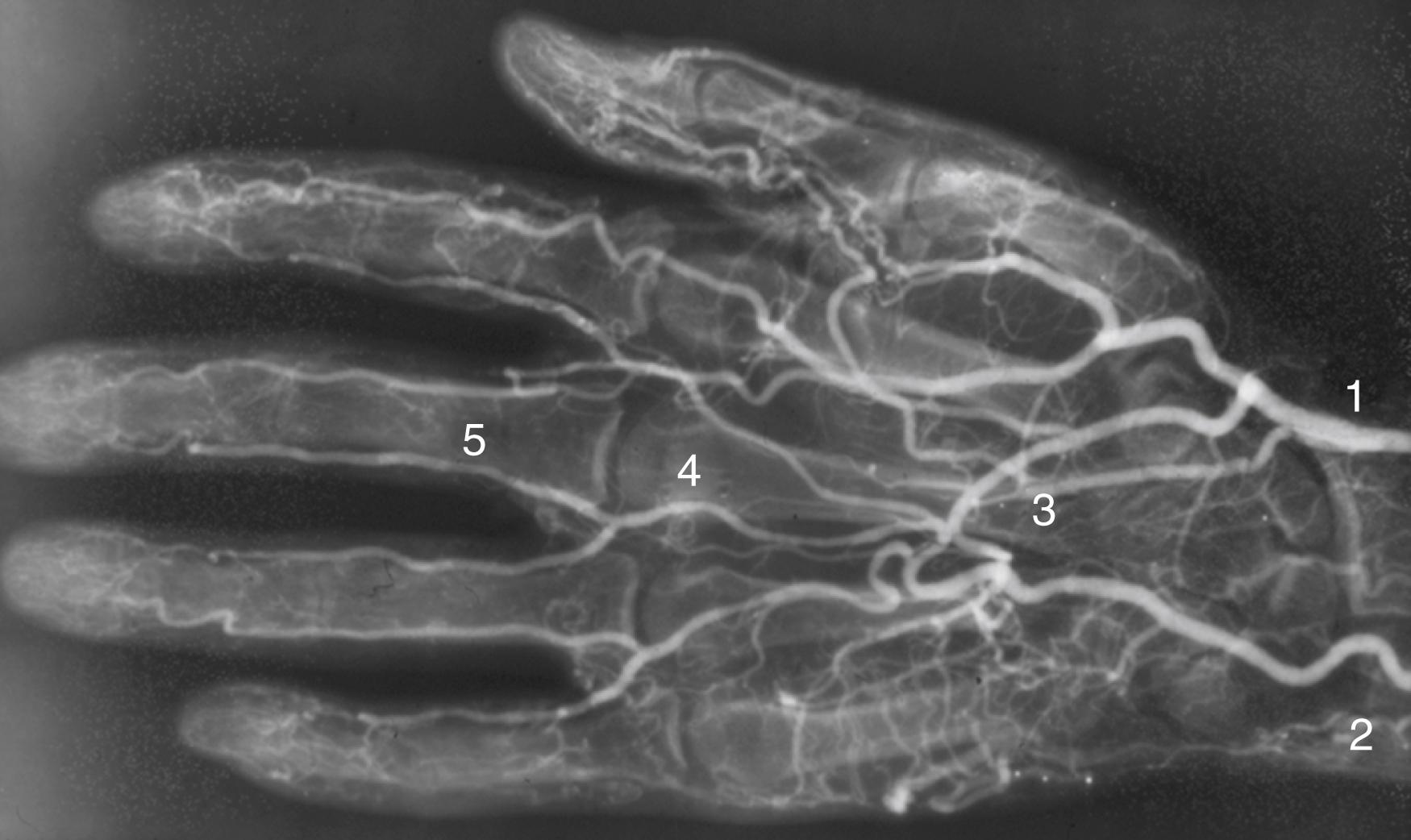 Figure 142.3, Normal hand arterial anatomy. 1 , radial artery; 2 , ulnar artery; 3 , deep palmer arch; 4 , common digital (metacarpal) artery; 5 , proper digital artery.