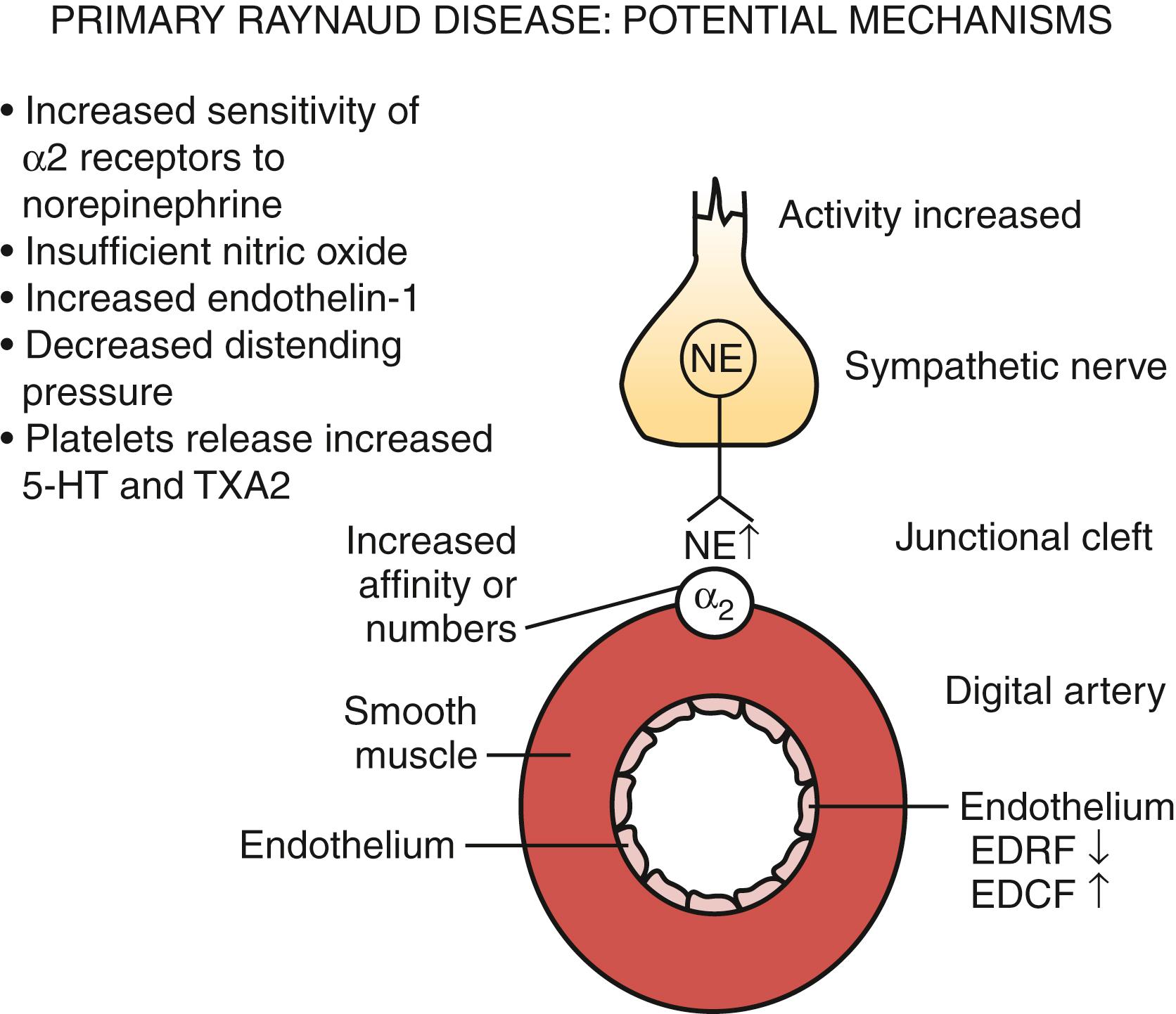 Figure 142.4, There are many potential causes of vasospastic attacks in primary Raynaud phenomenon. Norepinephrine (NE) released from the sympathetic nerve ending acts on the post junctional α-2 receptor located on vascular smooth muscle. Local cooling enhances the response of the α-2 receptor, thereby causing increased arterial contraction. Endothelial dysfunction may lead to insufficient nitric oxide or increased endothelin-1, which changes the balance toward arterial constriction. Activated platelets release thromboxane A2 (TXA2) and serotonin (5-hydroxytryptamine [5-HT] ), which may aggravate arterial vasospasm. A decrease in intraluminal distending pressure may decrease the “critical dosing pressure” threshold and result in a vasospastic attack.