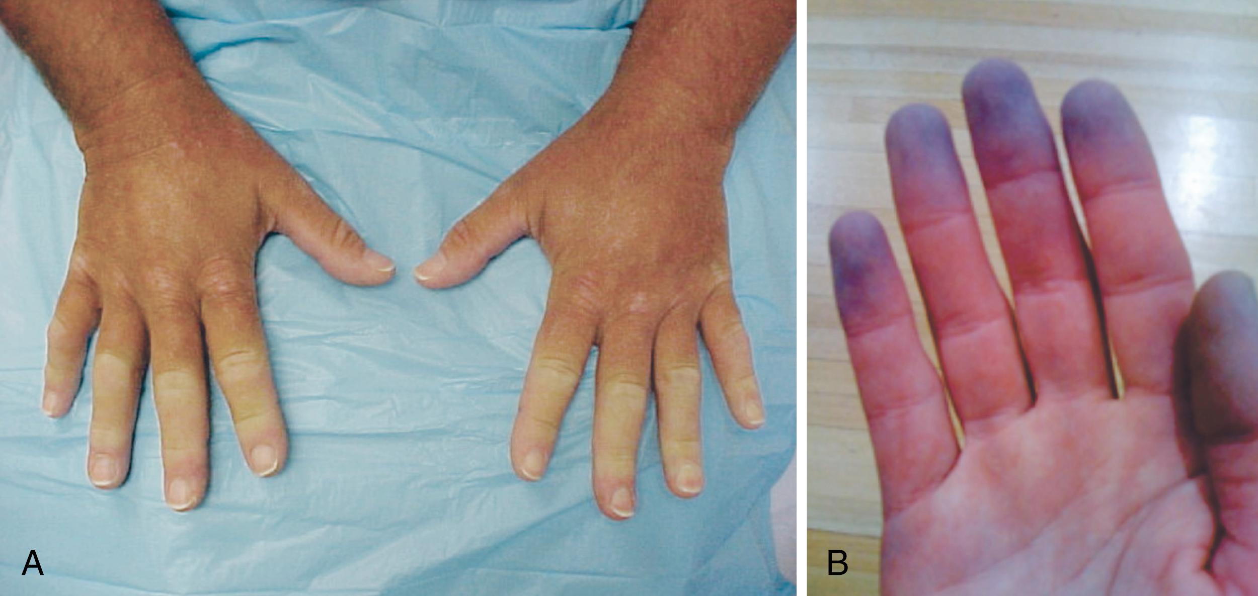 Fig. 30.1, A, Classic presentation of Raynaud phenomenon with symmetrical, sharply demarcated pallor affecting all fingers and sparing the thumbs. B, Cyanosis associated with Raynaud phenomenon typically follows pallor and represents deoxygenation of slow flowing blood.