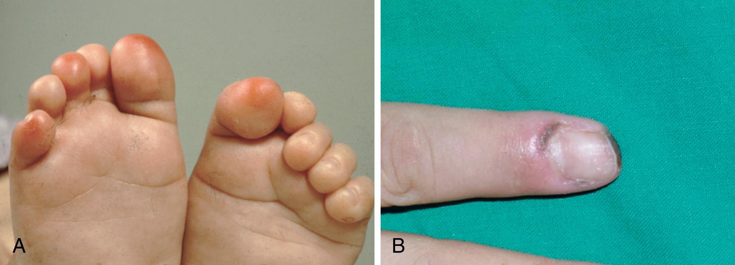 Fig. 30.2, A, Digital ischemia secondary to Raynaud phenomenon resulting in painful erythematous plaques (pernio) on the tips of affected toes. B, Necrosis of the fingertip and the proximal periungual area associated with Raynaud phenomenon.