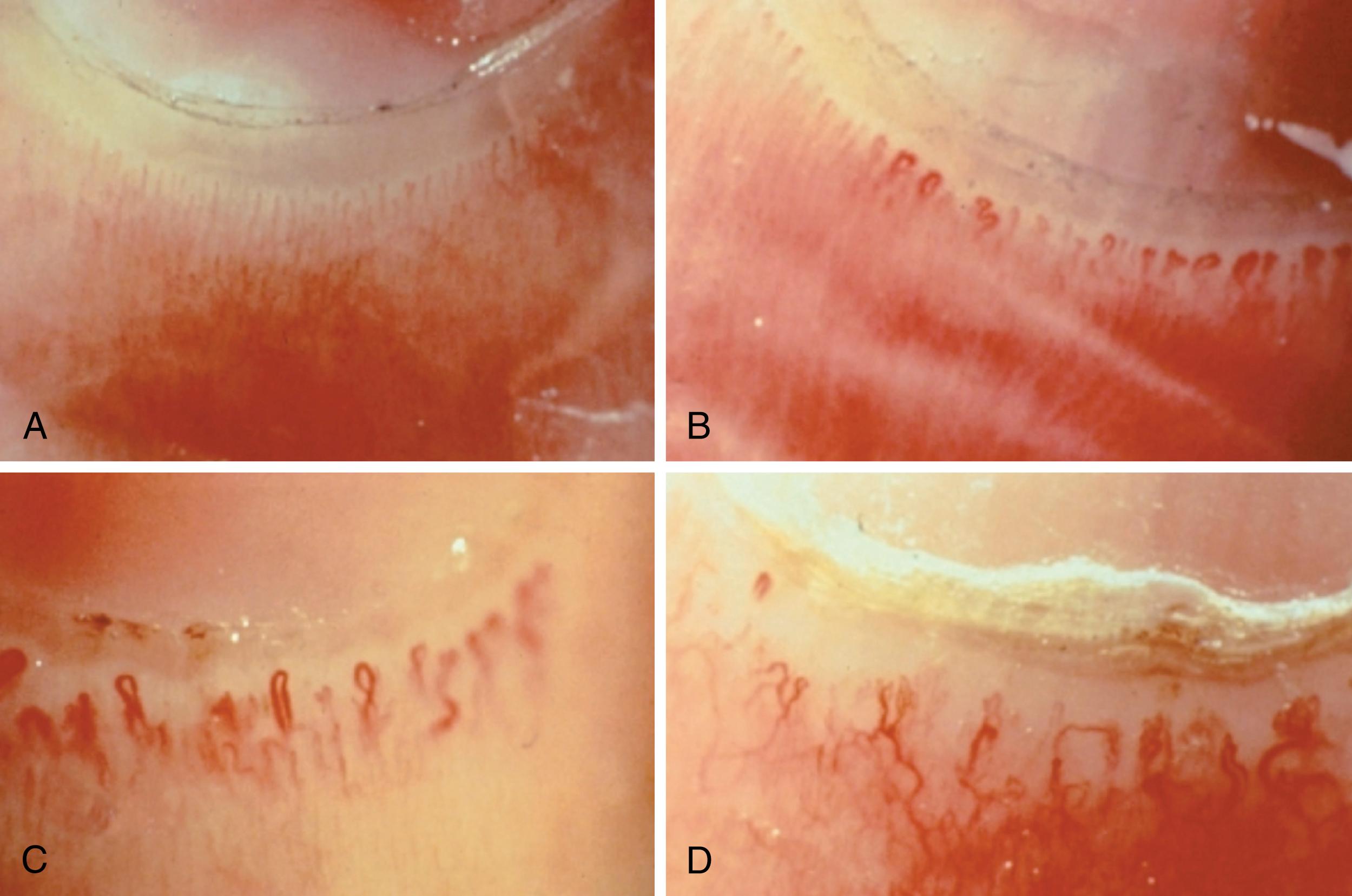 Fig. 30.3, Nailfold capillaroscopy. A, Normal nailfold capillary size and distribution ( top left ). B, Early changes of systemic sclerosis showing dilation, tortuosity, and disorganization ( top right ). C, Active stage systemic sclerosis showing increasingly disorganized architecture, giant capillaries and hemorrhage, decreased number of vessels, and increased frequency of abnormal vessels ( bottom left ). D, Late-stage systemic sclerosis showing severe dropout and abnormal vessels with arborization ( bottom right ).