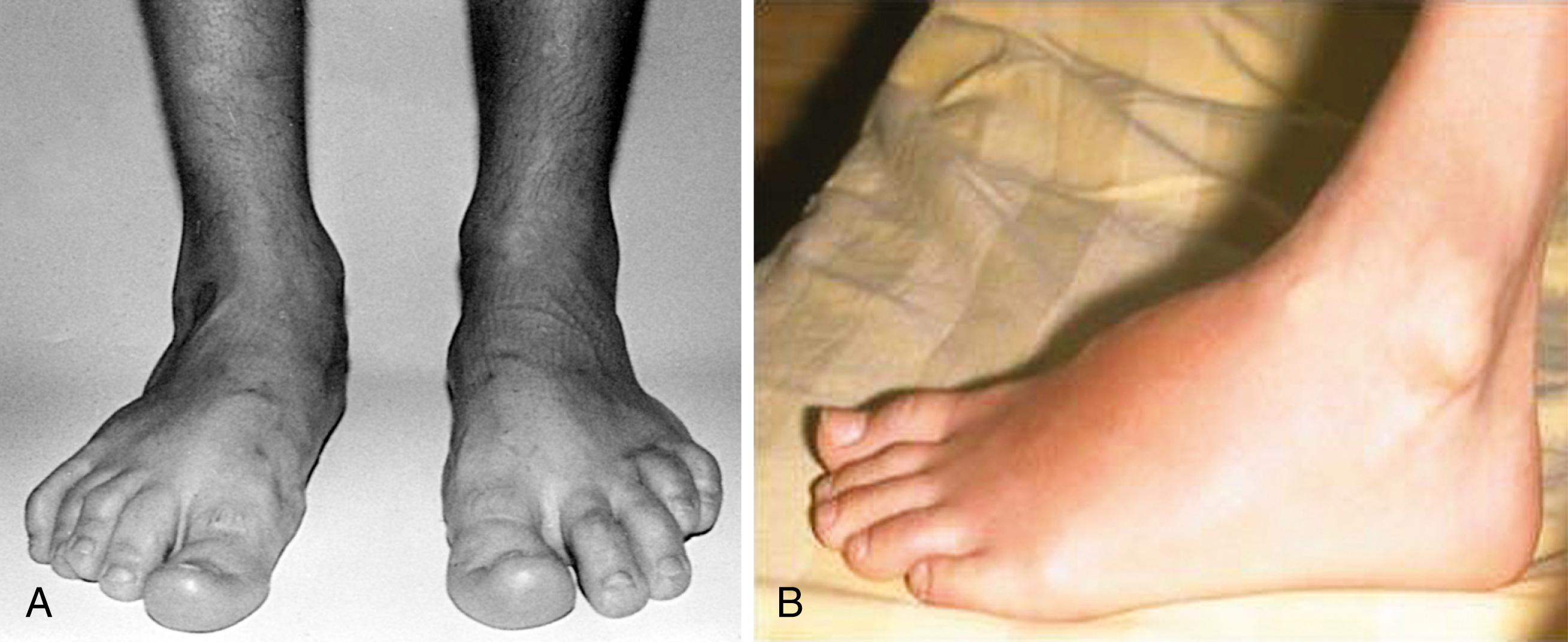 Fig. 46.2, A, There is slight swelling of the midfoot and dactylitis involving the second right toe and the fourth and fifth left toes in an adolescent with Salmonella -triggered reactive arthritis of 6 months’ duration. B, The foot of a teenage girl with post- Yersinia reactive arthritis showing swelling and erythema of the dorsum of the foot.