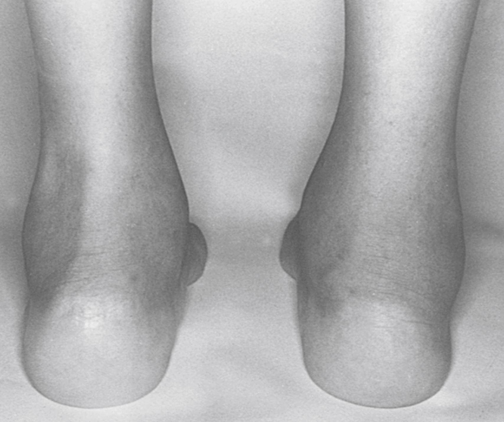 Fig. 46.3, Achilles tendinitis and swelling of the retrocalcaneal bursa of the right foot of a patient with reactive arthritis (ReA).