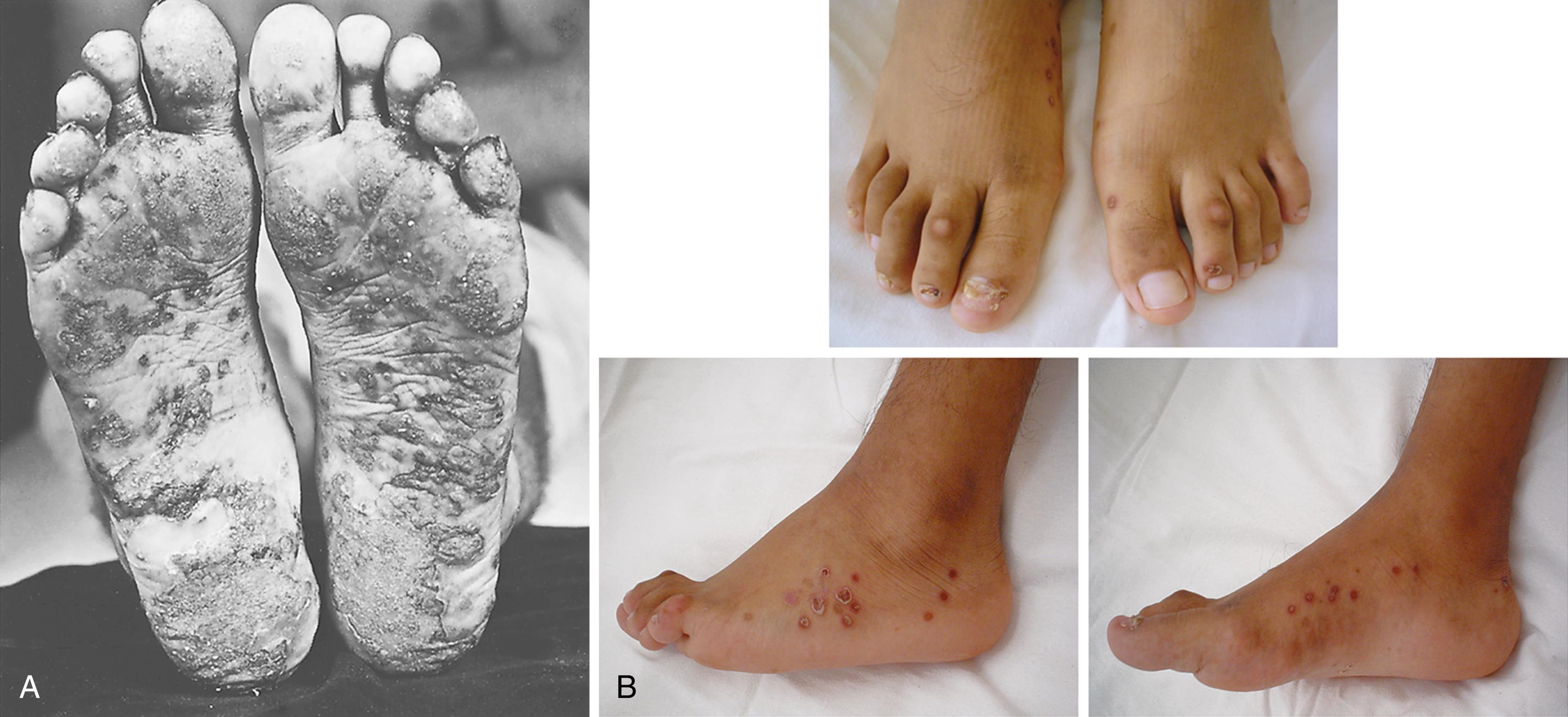 Fig. 46.5, Keratoderma blennorrhagicum. A, This scaly eruption on the soles of the feet of an 18-year-old youth with reactive arthritis is difficult to distinguish from psoriasis. B, Dorsal, lateral, and medial aspects of the feet of a 16-year-old patient with chronic reactive arthritis. Dorsal view: Although the third digit on the right foot shows some diffuse swelling and hyperpigmentation, the first toe looks more atrophic than its counterpart on the left foot. Lateral view: Midfoot and ankle swelling. All views: There is nail dystrophy of the first three digits in the right foot (clearly seen on the first toe) and multiple keratoderma blennorrhagic lesions. This patient had recurrent episodes of severe arthritis and enthesitis involving both feet but only later developed skin lesions.