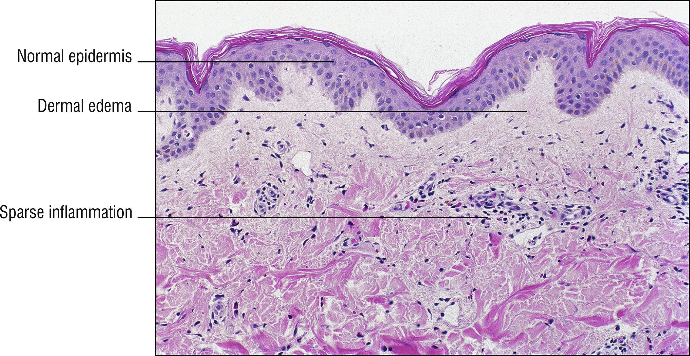 Fig. 3.1, Urticaria.