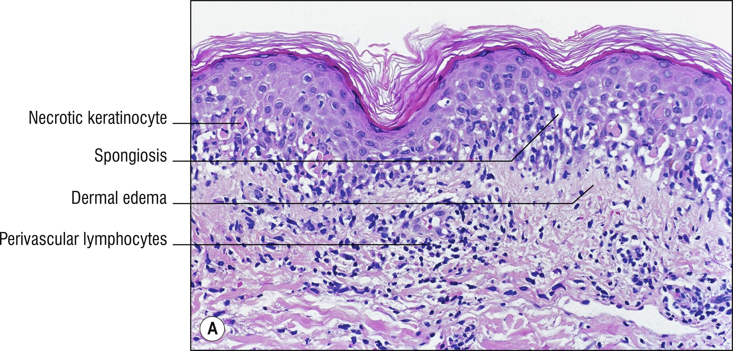 Fig. 3.2, A Erythema multiforme (low mag.).