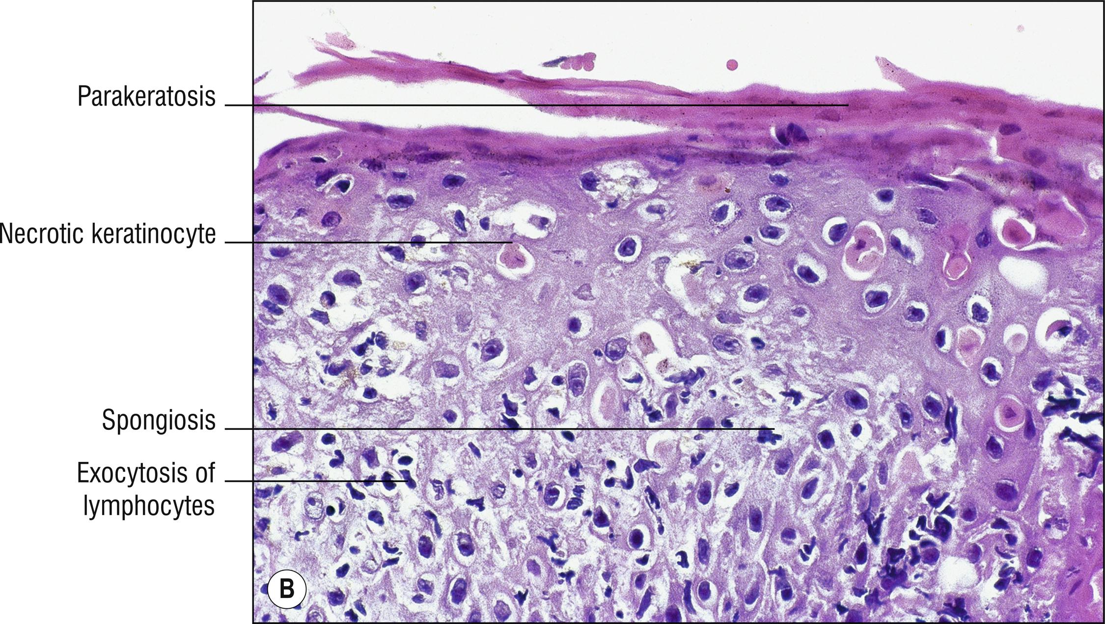 Fig. 3.2, B Erythema multiforme (high mag.).