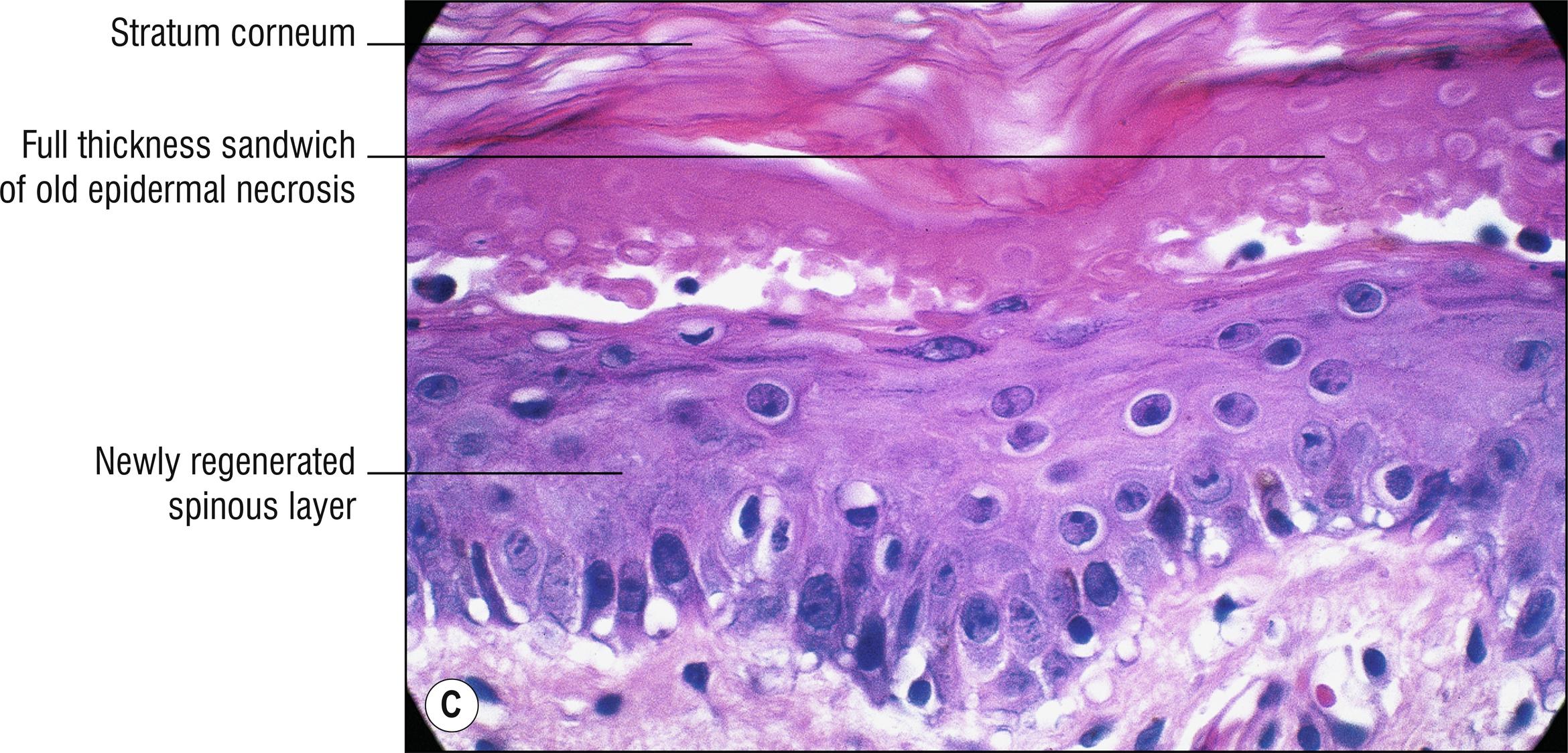 Fig. 3.2, C Erythema multiforme (re-epithelialization).