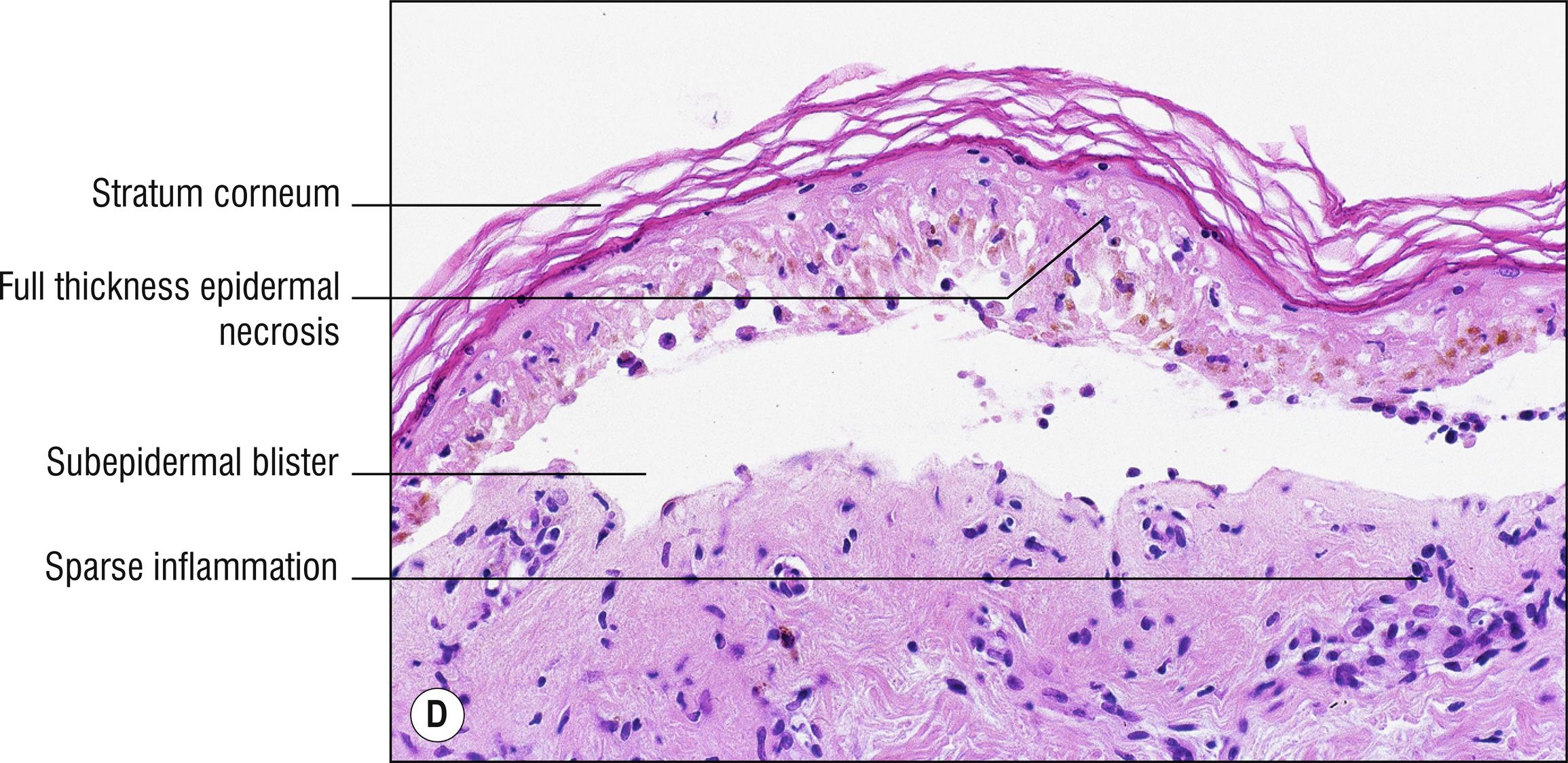 Fig. 3.2, D Toxic epidermal necrolysis.