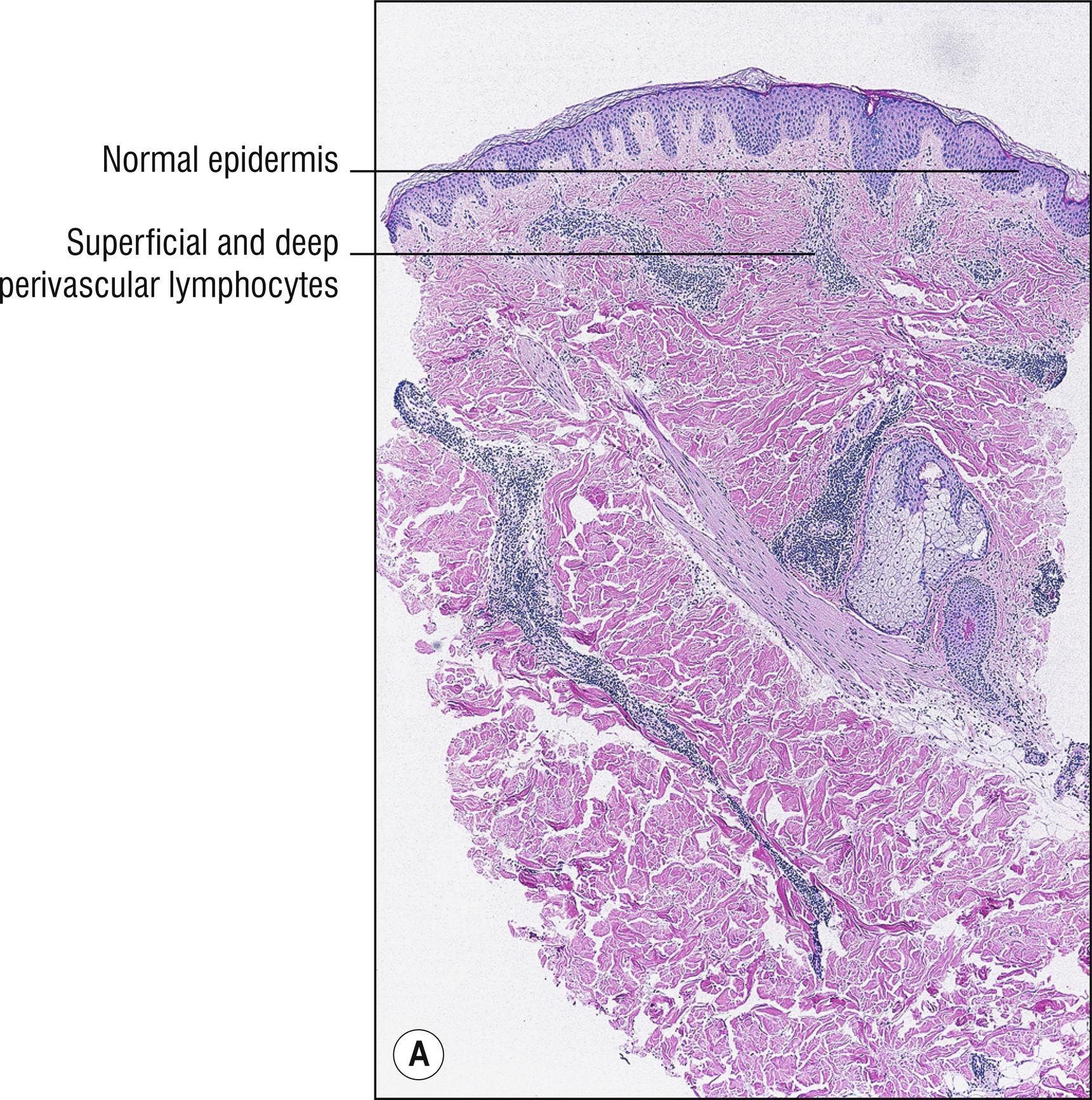 Fig. 3.3, A Erythema annulare centrifugum (low mag.).