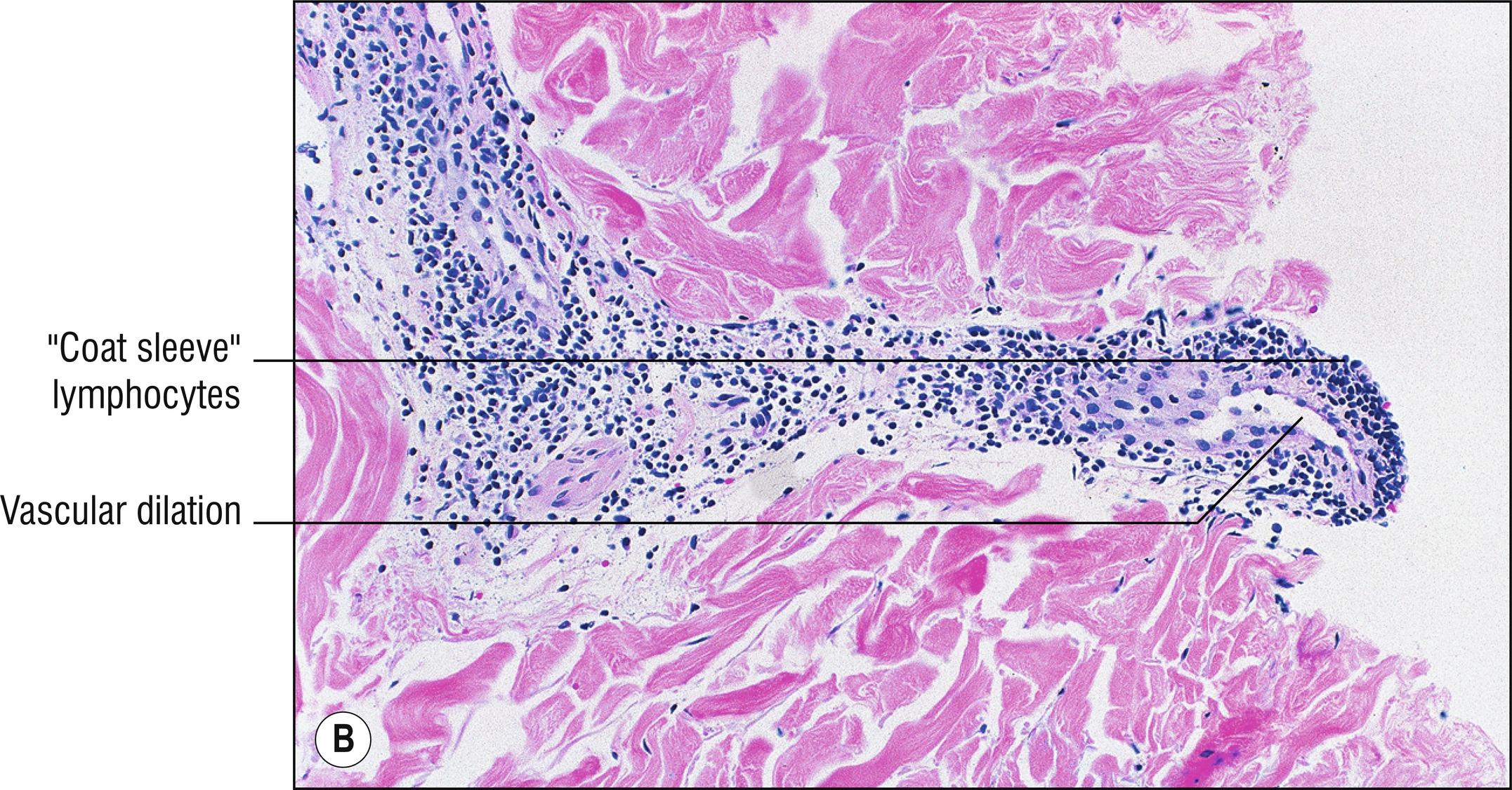 Fig. 3.3, B Erythema annulare centrifugum (high mag.).