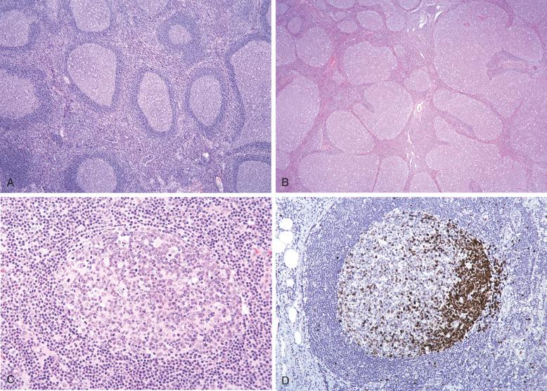 Figure 9-1, Follicular hyperplasia.