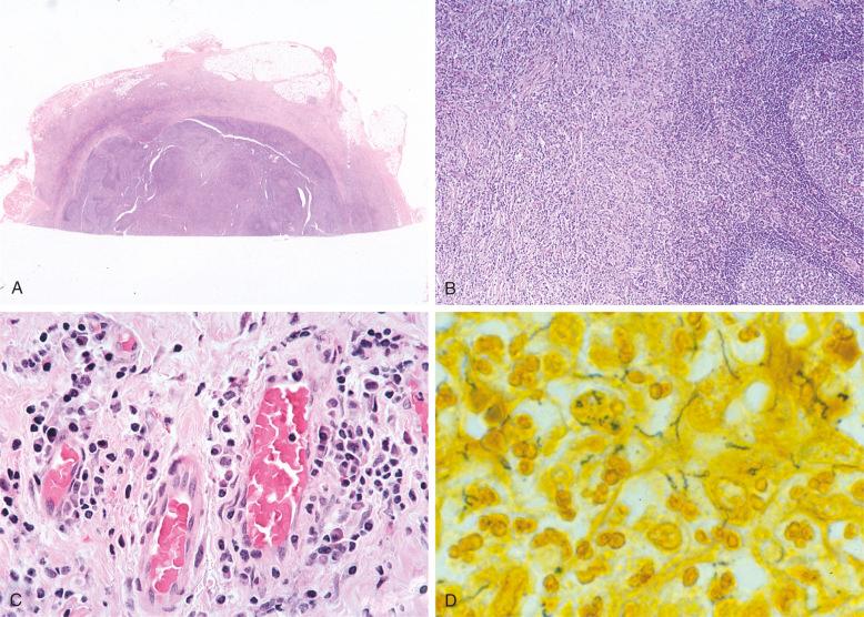 Figure 9-7, Syphilitic lymphadenitis.