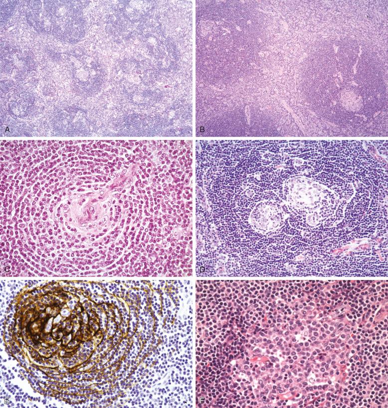 Figure 9-8, Hyaline vascular Castleman's disease.