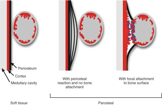 FIGURE 23-1, Myositis ossificans in relation to bone surface.