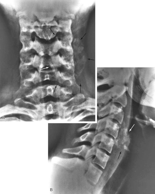 FIGURE 23-11, Myositis ossificans: radiographic features