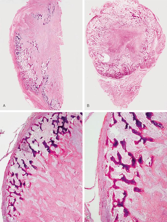 FIGURE 23-12, Myositis ossificans: microscopic features.