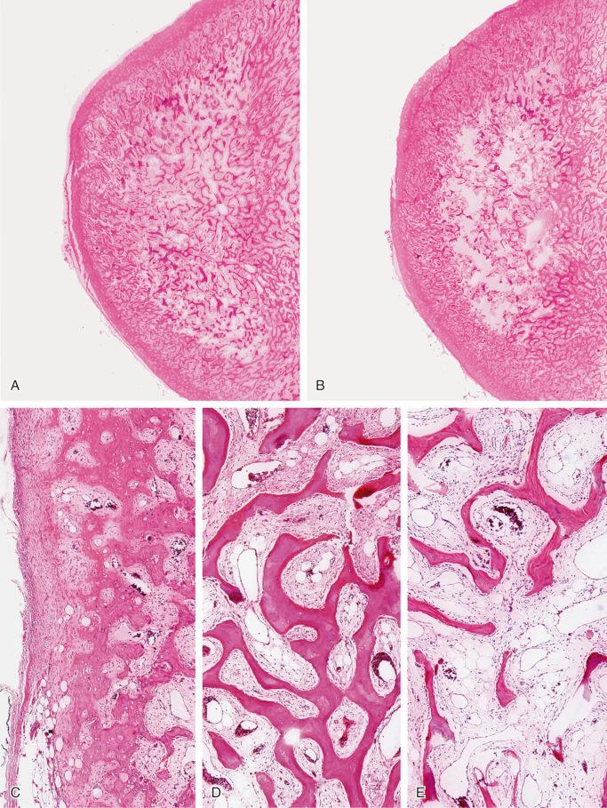 FIGURE 23-13, Myositis ossificans, mature phase: microscopic features.