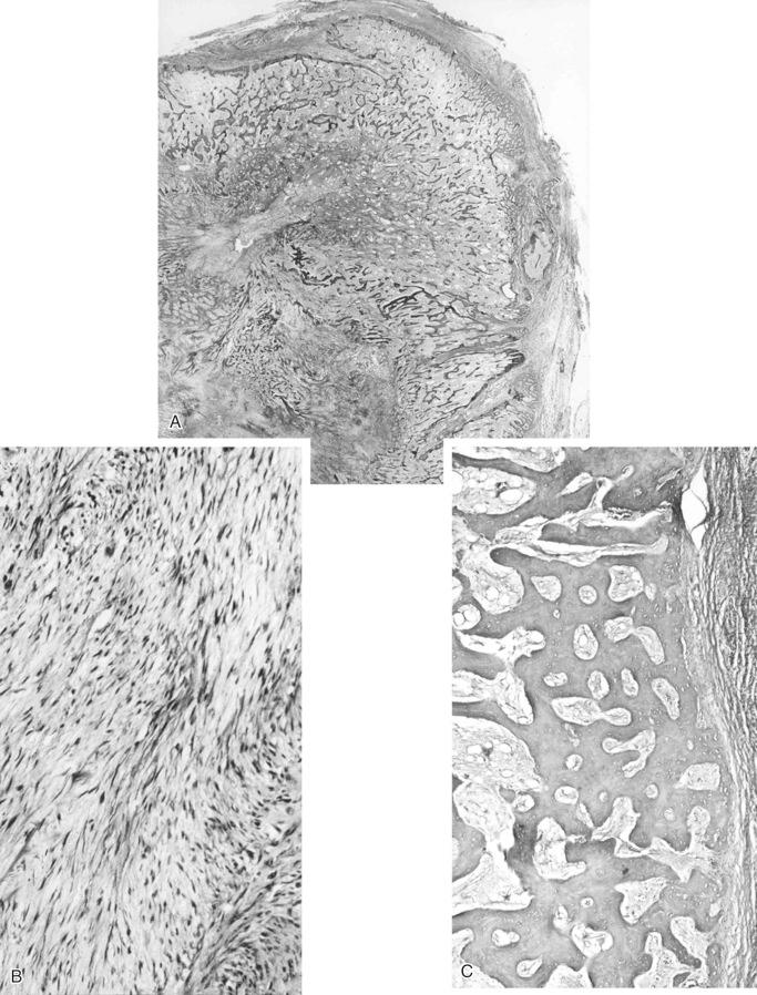 FIGURE 23-14, Myositis ossificans, mature phase: microscopic features.