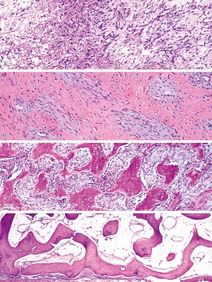 FIGURE 23-15, Myositis ossificans: microscopic features.