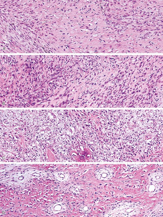 FIGURE 23-16, Myositis ossificans, early phase: miscroscopic features.