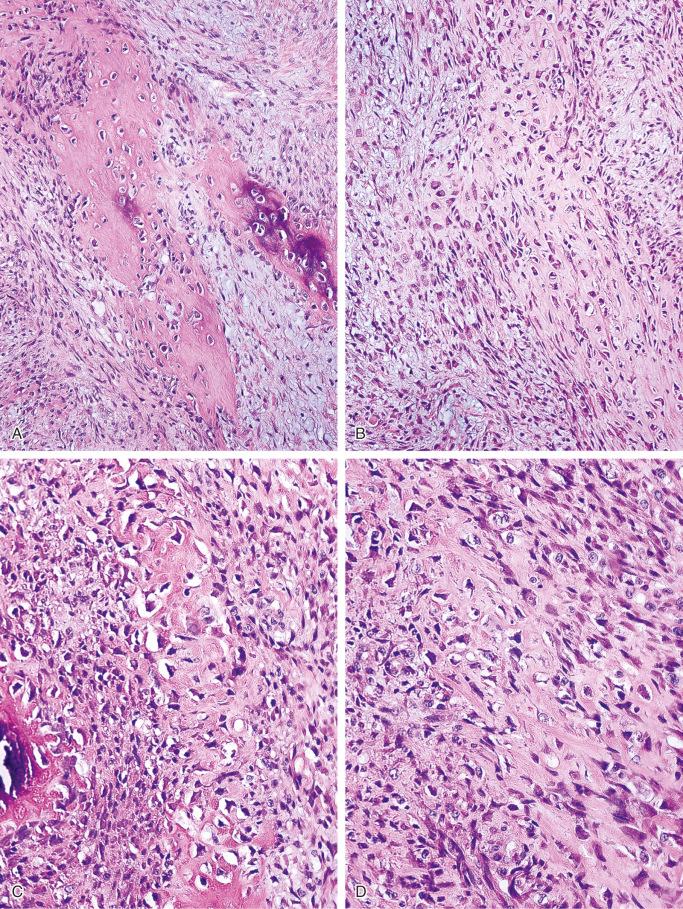 FIGURE 23-17, Myositis ossificans, early phase: microscopic features.