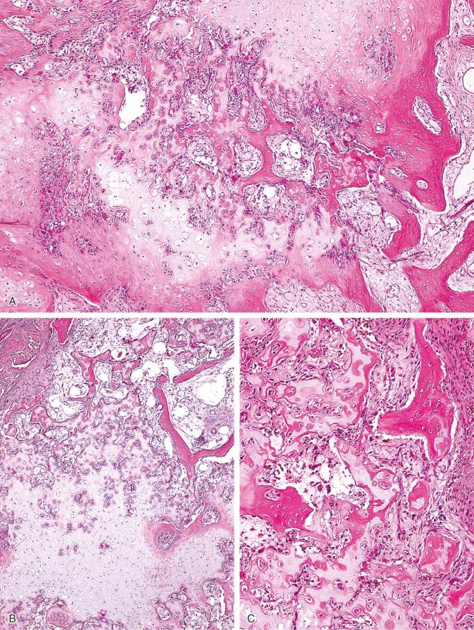 FIGURE 23-18, Parosteal myositis ossificans: microscopic features.
