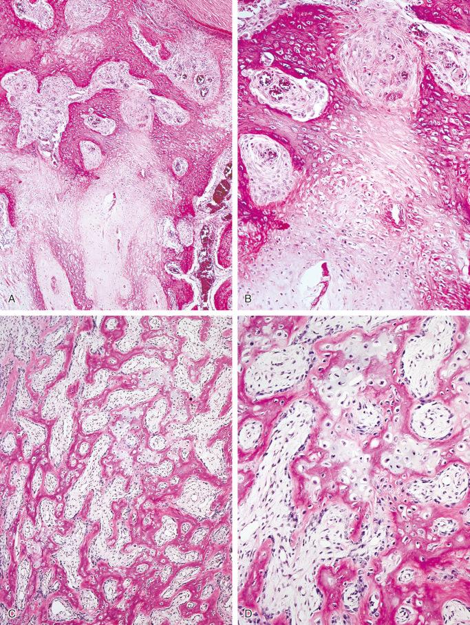 FIGURE 23-19, Parosteal myositis ossificans: microscopic features.