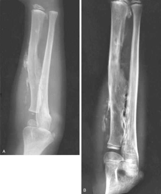 FIGURE 23-20, Myositis ossificans progressiva (fibrodysplasia ossificans progressiva): radiographic features.