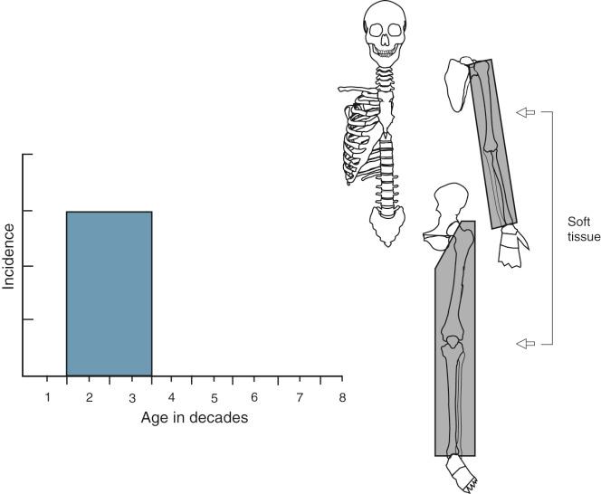 FIGURE 23-2, Myositis ossificans.