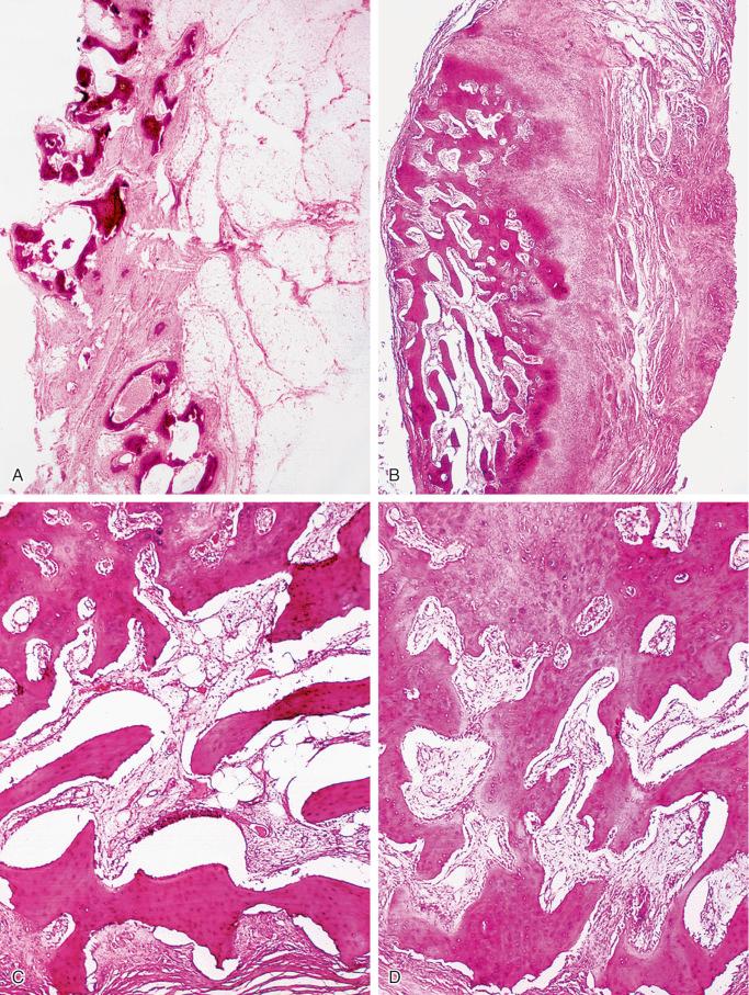 FIGURE 23-21, Myositis ossificans progressiva (fibrodysplasia ossificans progressiva): microscopic features.