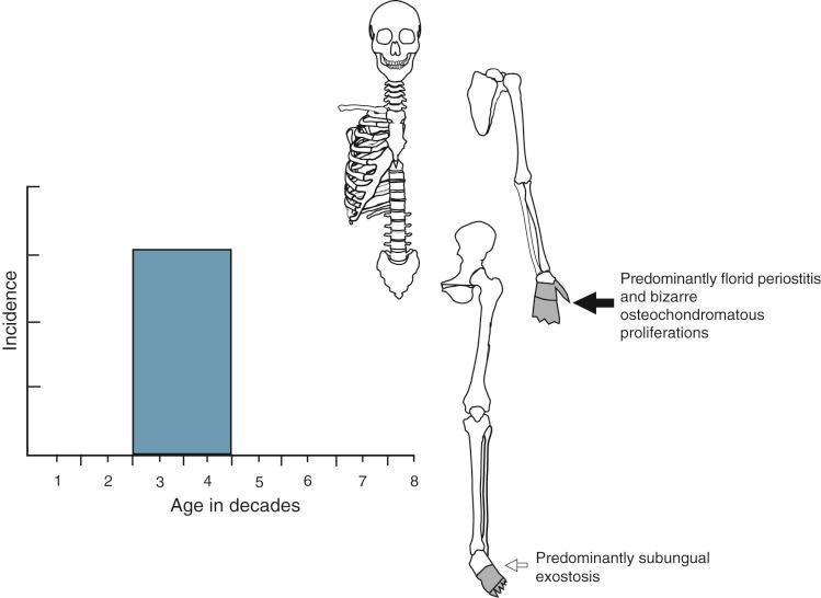 FIGURE 23-22, Reactive lesions of bone surface.