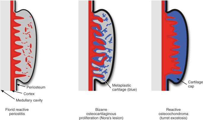 FIGURE 23-23, Unified concept of reactive lesions of bone surface.