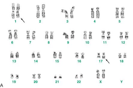 FIGURE 23-24, Bizarre parosteal osteocartilaginous proliferation (Nora's lesion): cytogenetic abnormalities.