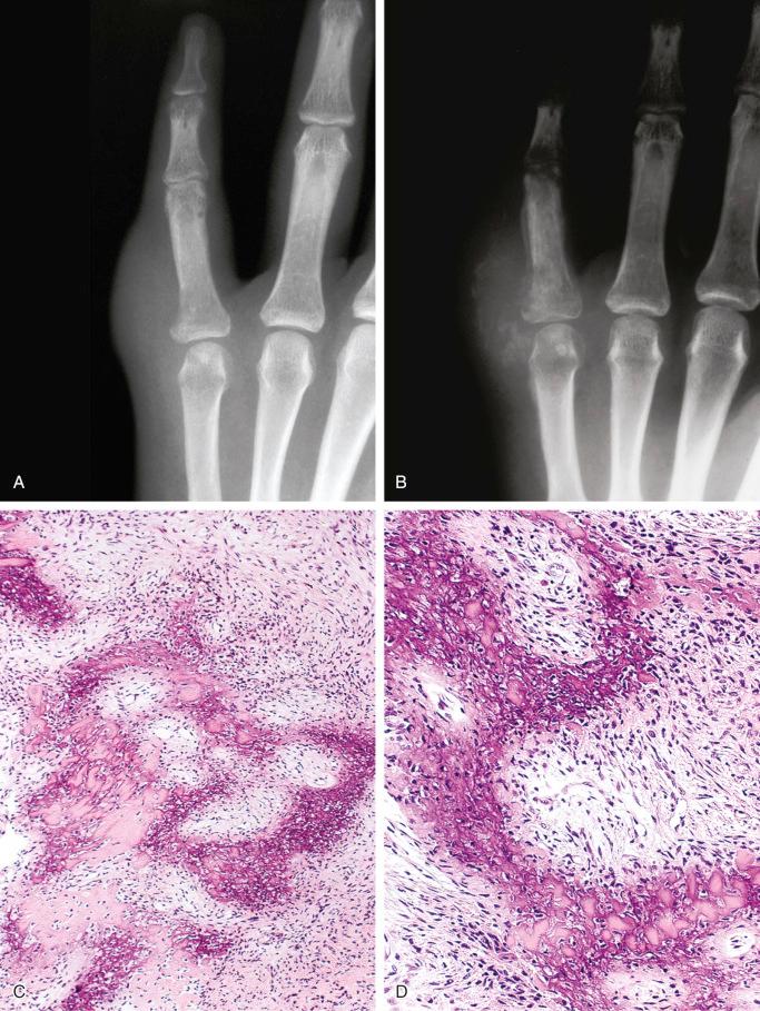 FIGURE 23-25, Florid reactive periostitis: radiographic and microscopic features.